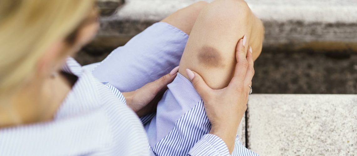 Contusion après un accident de voiture : symptômes, durée, traitements